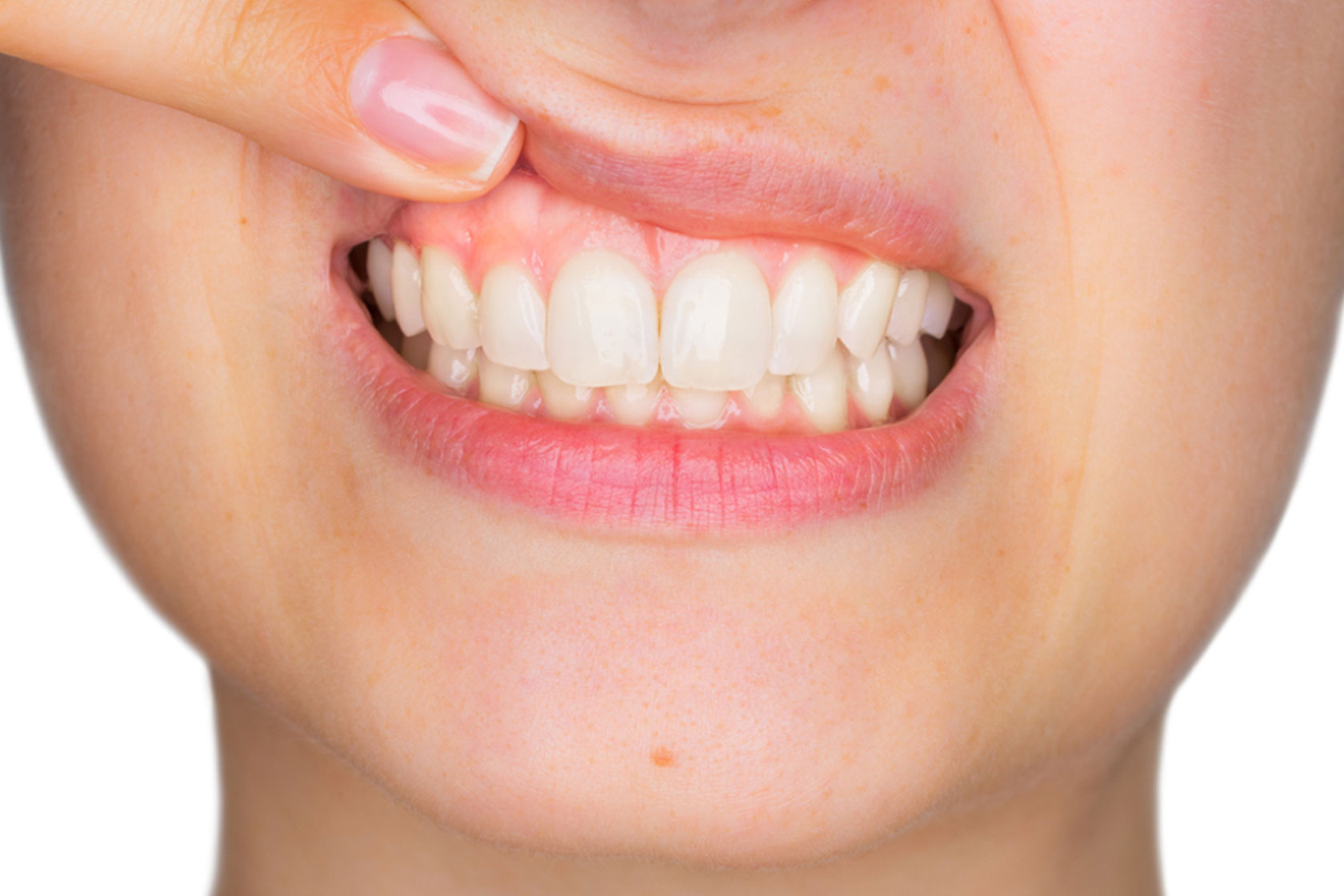 Gum Lift, Recontour & Reshaping Smile Studio Newstead